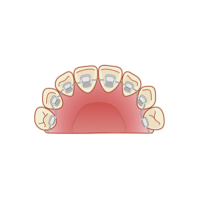 リンガルブラケット