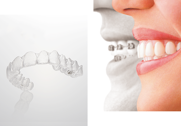 マウスピース矯正（インビザライン）